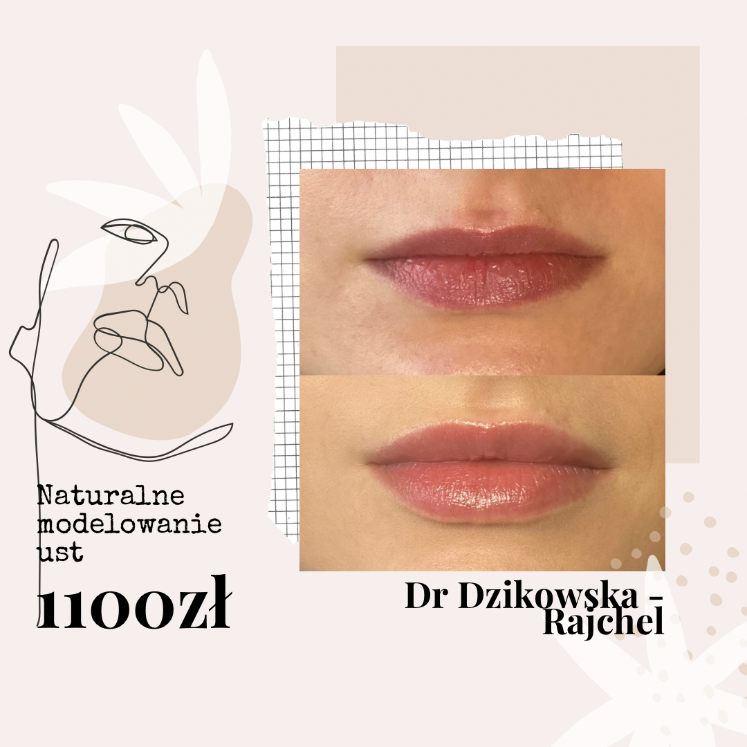Naturalne modelowanie i nawilżanie ust u dr Dzikowskiej Rajchel. 